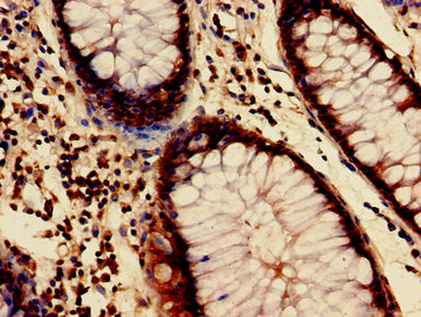 Immunohistochemistry of paraffin-embedded human colon cancer using HIST1H3A (Ab-4) Antibody at dilution of 1:100Rabbit anti-Human HIST1H3A Polyclonal Antibody