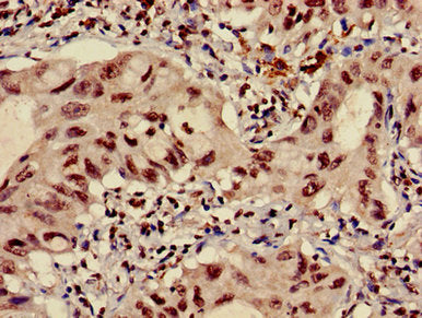 Immunohistochemistry of paraffin-embedded human lung cancer using HIST1H3A (Ab-4) Antibody at dilution of 1:100Rabbit anti-Human HIST1H3A Polyclonal Antibody