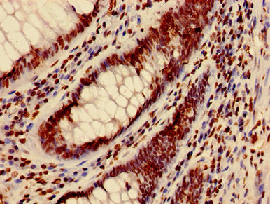 Immunohistochemistry of paraffin-embedded human colon cancer using HIST1H3A (Ab-4) Antibody at dilution of 1:100Rabbit anti-Human HIST1H3A Polyclonal Antibody