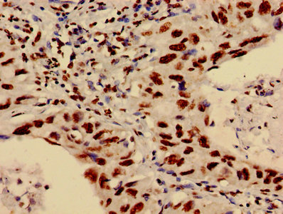 Immunohistochemistry of paraffin-embedded human lung cancer using HIST1H3A (Ab-4) Antibody at dilution of 1:100Rabbit anti-Human HIST1H3A Polyclonal Antibody