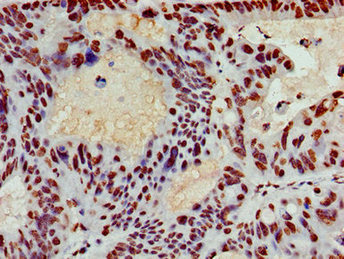 Immunohistochemistry of paraffin-embedded human colon cancer using HIST1H3A (Ab-4) Antibody at dilution of 1:100Rabbit anti-Human HIST1H3A Polyclonal Antibody