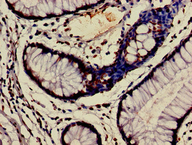 Immunohistochemistry of paraffin-embedded human colon cancer using HIST1H3A (Ab-9) Antibody at dilution of 1:100Rabbit anti-Human HIST1H3A Polyclonal Antibody