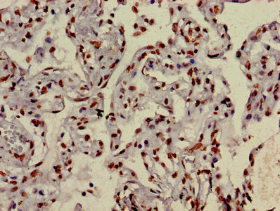 Immunohistochemistry of paraffin-embedded human lung cancer using HIST1H3A (Ab-9) Antibody at dilution of 1:100Rabbit anti-Human HIST1H3A Polyclonal Antibody