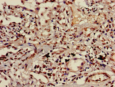 Immunohistochemistry of paraffin-embedded human lung cancer using HIST1H3A (Ab-9) Antibody at dilution of 1:100Rabbit anti-Human HIST1H3A Polyclonal Antibody