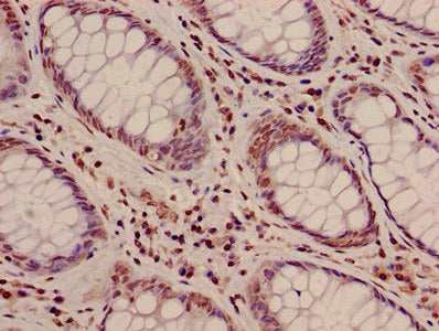 Immunohistochemistry of paraffin-embedded human colon cancer using HIST1H3A (Ab-10) Antibody at dilution of 1:100Rabbit anti-Human HIST1H3A Polyclonal Antibody
