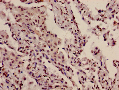 Immunohistochemistry of paraffin-embedded human lung cancer using HIST1H3A (Ab-10) Antibody at dilution of 1:100Rabbit anti-Human HIST1H3A Polyclonal Antibody