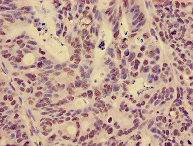 Immunohistochemistry of paraffin-embedded human colon cancer using HIST1H3A (Ab-14) Antibody at dilution of 1:100Rabbit anti-Human HIST1H3A Polyclonal Antibody