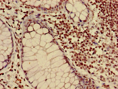 Immunohistochemistry of paraffin-embedded human colon cancer using HIST1H3A (Ab-17) Antibody at dilution of 1:100Rabbit anti-Human HIST1H3A Polyclonal Antibody