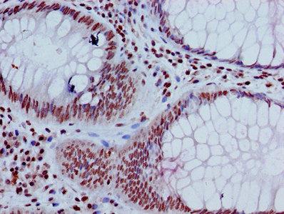 Immunohistochemistry of paraffin-embedded human colon cancer using HIST1H3A (Ab-17) Antibody at dilution of 1:100Rabbit anti-Human HIST1H3A Polyclonal Antibody