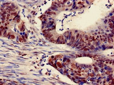 Immunohistochemistry of paraffin-embedded human colon cancer using the antibody at dilution of 1:100Rabbit anti-Human HIST1H3A Polyclonal Antibody