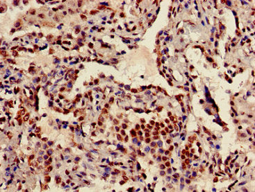 Immunohistochemistry of paraffin-embedded human lung cancer using HIST1H3A (Ab-18) Antibody at dilution of 1:100Rabbit anti-Human HIST1H3A Polyclonal Antibody