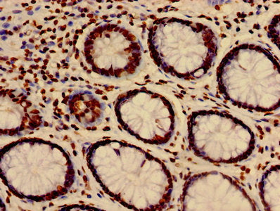 Immunohistochemistry of paraffin-embedded human colon cancer using HIST1H3A (Ab-27) Antibody at dilution of 1:100Rabbit anti-Human HIST1H3A Polyclonal Antibody
