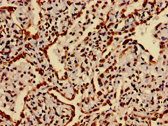 Immunohistochemistry of paraffin-embedded human lung cancer using HIST1H3A (Ab-27) Antibody at dilution of 1:100Rabbit anti-Human HIST1H3A Polyclonal Antibody