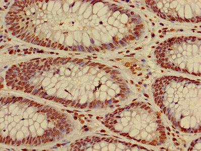 Immunohistochemistry of paraffin-embedded human colon cancer using HIST1H3A (Ab-27) Antibody at dilution of 1:100Rabbit anti-Human HIST1H3A Polyclonal Antibody