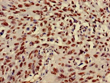 Immunohistochemistry of paraffin-embedded human lung cancer using HIST1H3A (Ab-27) Antibody at dilution of 1:100Rabbit anti-Human HIST1H3A Polyclonal Antibody