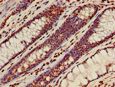Immunohistochemistry of paraffin-embedded human colon cancer using HIST1H3A (Ab-36) Antibody at dilution of 1:100Rabbit anti-Human HIST1H3A Polyclonal Antibody