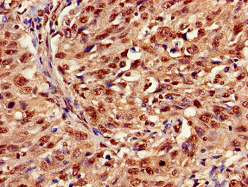 Immunohistochemistry of paraffin-embedded human lung cancer using HIST1H3A (Ab-36) Antibody at dilution of 1:100Rabbit anti-Human HIST1H3A Polyclonal Antibody