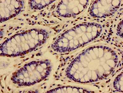 Immunohistochemistry of paraffin-embedded human colon cancer using HIST1H3A (Ab-36) Antibody at dilution of 1:100Rabbit anti-Human HIST1H3A Polyclonal Antibody