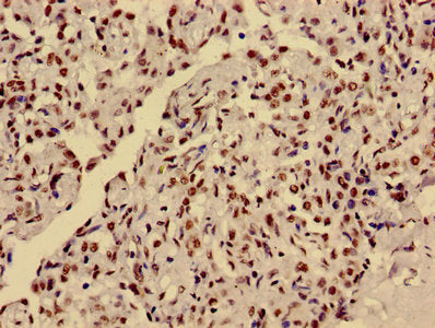Immunohistochemistry of paraffin-embedded human lung cancer using HIST1H3A (Ab-36) Antibody at dilution of 1:100Rabbit anti-Human HIST1H3A Polyclonal Antibody