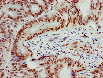 Immunohistochemistry of paraffin-embedded human colon cancer using HIST1H4A (Ab-16) Antibody at dilution of 1:100Rabbit anti-Human HIST1H4A Polyclonal Antibody