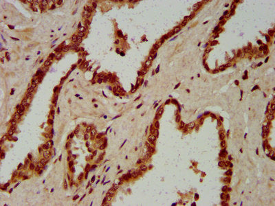 IHC image of HIST1H4A (Ab-1) Antibody diluted at 1:50 and staining in paraffin-embedded human prostate cancer performed on a Leica BondTM system. After dewaxing and hydration, antigen retrieval was mediated by high pressure in a citrate buffer (pH 6.0). Section was blocked with 10% normal goat serum 30min at RT. Then primary antibody (1% BSA) was incubated at 4°C overnight. The primary is detected by a biotinylated secondary antibody and visualized using an HRP conjugated SP system.Rabbit anti-Human HIST1H4A Polyclonal Antibody