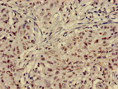 Immunohistochemistry of paraffin-embedded human lung cancer using HIST1H4A (Ab-5) Antibody at dilution of 1:100Rabbit anti-Human HIST1H4A Polyclonal Antibody
