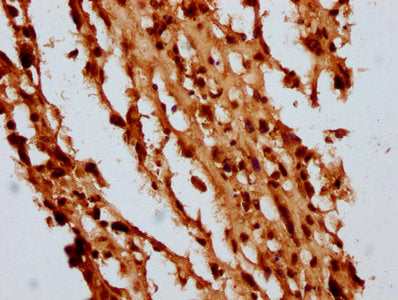 IHC image of the antibody diluted at 1:10 and staining in paraffin-embedded human melanoma performed on a Leica BondTM system. After dewaxing and hydration, antigen retrieval was mediated by high pressure in a citrate buffer (pH 6.0). Section was blocked with 10% normal goat serum 30min at RT. Then primary antibody (1% BSA) was incubated at 4°C overnight. The primary is detected by a biotinylated secondary antibody and visualized using an HRP conjugated SP system.Rabbit anti-Human HIST1H4A Polyclonal Antibody