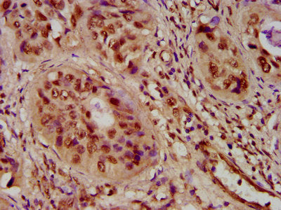 IHC image of HIST1H4A (Ab-5) Antibody diluted at 1:100 and staining in paraffin-embedded human cervical cancer performed on a Leica BondTM system. After dewaxing and hydration, antigen retrieval was mediated by high pressure in a citrate buffer (pH 6.0). Section was blocked with 10% normal goat serum 30min at RT. Then primary antibody (1% BSA) was incubated at 4°C overnight. The primary is detected by a biotinylated secondary antibody and visualized using an HRP conjugated SP system.Rabbit anti-Human HIST1H4A Polyclonal Antibody