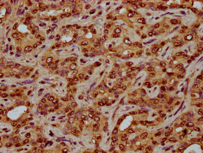 IHC image of the antibody diluted at 1:3 and staining in paraffin-embedded human liver cancer performed on a Leica BondTM system. After dewaxing and hydration, antigen retrieval was mediated by high pressure in a citrate buffer (pH 6.0). Section was blocked with 10% normal goat serum 30min at RT. Then primary antibody (1% BSA) was incubated at 4°C overnight. The primary is detected by a biotinylated secondary antibody and visualized using an HRP conjugated SP system.Rabbit anti-Human HIST1H4A Polyclonal Antibody