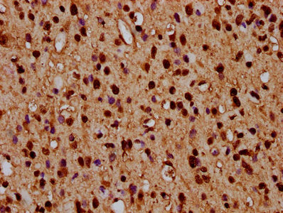 IHC image of HIST1H4A (Ab-5) Antibody diluted at 1:3 and staining in paraffin-embedded human glioma performed on a Leica BondTM system. After dewaxing and hydration, antigen retrieval was mediated by high pressure in a citrate buffer (pH 6.0). Section was blocked with 10% normal goat serum 30min at RT. Then primary antibody (1% BSA) was incubated at 4°C overnight. The primary is detected by a biotinylated secondary antibody and visualized using an HRP conjugated SP system.Rabbit anti-Human HIST1H4A Polyclonal Antibody