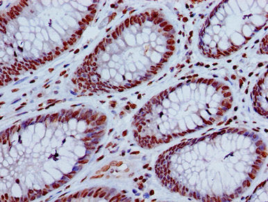 Immunohistochemistry of paraffin-embedded human colon cancer using HIST1H4A (Ab-8) Antibody at dilution of 1:100Rabbit anti-Human HIST1H4A Polyclonal Antibody