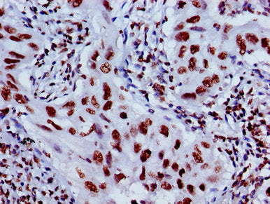 Immunohistochemistry of paraffin-embedded human lung cancer using HIST1H4A (Ab-8) Antibody at dilution of 1:100Rabbit anti-Human HIST1H4A Polyclonal Antibody
