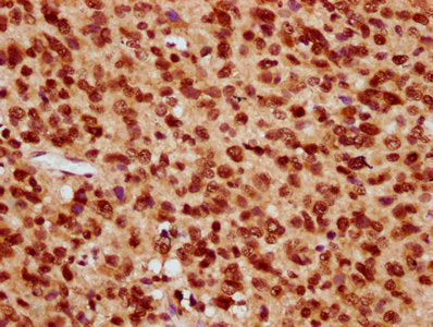 IHC image of HIST1H4A (Ab-8) Antibody diluted at 1:20 and staining in paraffin-embedded human glioma performed on a Leica BondTM system. After dewaxing and hydration, antigen retrieval was mediated by high pressure in a citrate buffer (pH 6.0). Section was blocked with 10% normal goat serum 30min at RT. Then primary antibody (1% BSA) was incubated at 4°C overnight. The primary is detected by a biotinylated secondary antibody and visualized using an HRP conjugated SP system.Rabbit anti-Human HIST1H4A Polyclonal Antibody