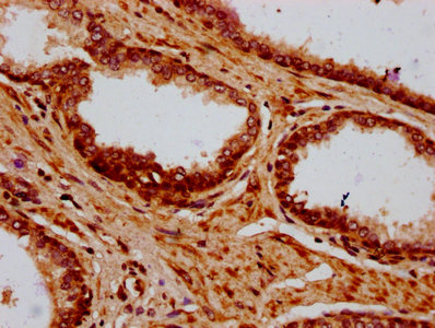 IHC image of HIST1H4A (Ab-8) Antibody diluted at 1:5 and staining in paraffin-embedded human prostate cancer performed on a Leica BondTM system. After dewaxing and hydration, antigen retrieval was mediated by high pressure in a citrate buffer (pH 6.0). Section was blocked with 10% normal goat serum 30min at RT. Then primary antibody (1% BSA) was incubated at 4°C overnight. The primary is detected by a biotinylated secondary antibody and visualized using an HRP conjugated SP system.Rabbit anti-Human HIST1H4A Polyclonal Antibody