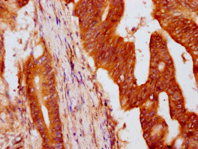IHC image of HIST1H4A (Ab-8) Antibody diluted at 1:5 and staining in paraffin-embedded human colon cancer performed on a Leica BondTM system. After dewaxing and hydration, antigen retrieval was mediated by high pressure in a citrate buffer (pH 6.0). Section was blocked with 10% normal goat serum 30min at RT. Then primary antibody (1% BSA) was incubated at 4°C overnight. The primary is detected by a biotinylated secondary antibody and visualized using an HRP conjugated SP system.Rabbit anti-Human HIST1H4A Polyclonal Antibody