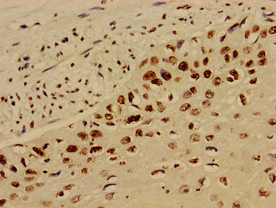 Immunohistochemistry of paraffin-embedded human cervical cancer using HIST1H4A (Ab-12) Antibody at dilution of 1:100Rabbit anti-Human HIST1H4A Polyclonal Antibody