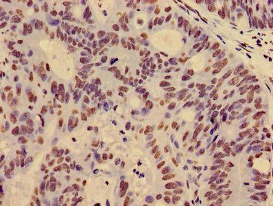 Immunohistochemistry of paraffin-embedded human colon cancer using HIST1H4A (Ab-12) Antibody at dilution of 1:100Rabbit anti-Human HIST1H4A Polyclonal Antibody