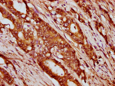 IHC image of HIST1H4A (Ab-12) Antibody diluted at 1:20 and staining in paraffin-embedded human colon cancer performed on a Leica BondTM system. After dewaxing and hydration, antigen retrieval was mediated by high pressure in a citrate buffer (pH 6.0). Section was blocked with 10% normal goat serum 30min at RT. Then primary antibody (1% BSA) was incubated at 4°C overnight. The primary is detected by a biotinylated secondary antibody and visualized using an HRP conjugated SP system.Rabbit anti-Human HIST1H4A Polyclonal Antibody