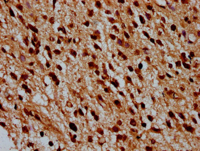 IHC image of the antibody diluted at 1:100 and staining in paraffin-embedded human glioma performed on a Leica BondTM system. After dewaxing and hydration, antigen retrieval was mediated by high pressure in a citrate buffer (pH 6.0). Section was blocked with 10% normal goat serum 30min at RT. Then primary antibody (1% BSA) was incubated at 4°C overnight. The primary is detected by a biotinylated secondary antibody and visualized using an HRP conjugated SP system.Rabbit anti-Human HIST1H4A Polyclonal Antibody