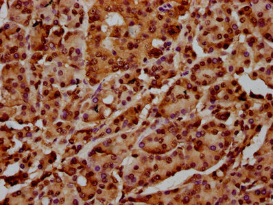 IHC image of HIST1H4A (Ab-12) Antibody diluted at 1:100 and staining in paraffin-embedded human pancreatic cancer performed on a Leica BondTM system. After dewaxing and hydration, antigen retrieval was mediated by high pressure in a citrate buffer (pH 6.0). Section was blocked with 10% normal goat serum 30min at RT. Then primary antibody (1% BSA) was incubated at 4°C overnight. The primary is detected by a biotinylated secondary antibody and visualized using an HRP conjugated SP system.Rabbit anti-Human HIST1H4A Polyclonal Antibody