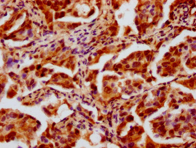 IHC image of the antibody diluted at 1:20 and staining in paraffin-embedded human lung cancer performed on a Leica BondTM system. After dewaxing and hydration, antigen retrieval was mediated by high pressure in a citrate buffer (pH 6.0). Section was blocked with 10% normal goat serum 30min at RT. Then primary antibody (1% BSA) was incubated at 4°C overnight. The primary is detected by a biotinylated secondary antibody and visualized using an HRP conjugated SP system.Rabbit anti-Human HIST1H4A Polyclonal Antibody
