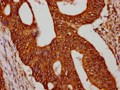 IHC image of the antibody diluted at 1:75 and staining in paraffin-embedded human colon cancer performed on a Leica BondTM system. After dewaxing and hydration, antigen retrieval was mediated by high pressure in a citrate buffer (pH 6.0). Section was blocked with 10% normal goat serum 30min at RT. Then primary antibody (1% BSA) was incubated at 4°C overnight. The primary is detected by a biotinylated secondary antibody and visualized using an HRP conjugated SP system.Rabbit anti-Human HIST1H4A Polyclonal Antibody