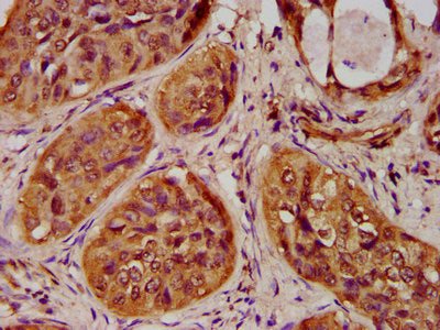 IHC image of the antibody diluted at 1:100 and staining in paraffin-embedded human cervical cancer performed on a Leica BondTM system. After dewaxing and hydration, antigen retrieval was mediated by high pressure in a citrate buffer (pH 6.0). Section was blocked with 10% normal goat serum 30min at RT. Then primary antibody (1% BSA) was incubated at 4°C overnight. The primary is detected by a biotinylated secondary antibody and visualized using an HRP conjugated SP system.Rabbit anti-Human HIST1H4A Polyclonal Antibody