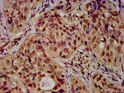 IHC image of HIST1H4A (Ab-31) Antibody diluted at 1:30 and staining in paraffin-embedded human cervical cancer performed on a Leica BondTM system. After dewaxing and hydration, antigen retrieval was mediated by high pressure in a citrate buffer (pH 6.0). Section was blocked with 10% normal goat serum 30min at RT. Then primary antibody (1% BSA) was incubated at 4°C overnight. The primary is detected by a biotinylated secondary antibody and visualized using an HRP conjugated SP system.Rabbit anti-Human HIST1H4A Polyclonal Antibody