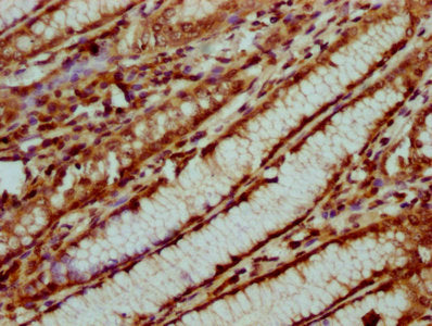 IHC image of the antibody diluted at 1:20 and staining in paraffin-embedded human gastric cancer performed on a Leica BondTM system. After dewaxing and hydration, antigen retrieval was mediated by high pressure in a citrate buffer (pH 6.0). Section was blocked with 10% normal goat serum 30min at RT. Then primary antibody (1% BSA) was incubated at 4°C overnight. The primary is detected by a biotinylated secondary antibody and visualized using an HRP conjugated SP system.Rabbit anti-Human HIST1H4A Polyclonal Antibody