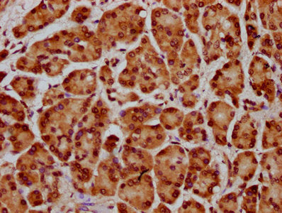 IHC image of HIST1H4A (Ab-31) Antibody diluted at 1:20 and staining in paraffin-embedded human pancreatic cancer performed on a Leica BondTM system. After dewaxing and hydration, antigen retrieval was mediated by high pressure in a citrate buffer (pH 6.0). Section was blocked with 10% normal goat serum 30min at RT. Then primary antibody (1% BSA) was incubated at 4°C overnight. The primary is detected by a biotinylated secondary antibody and visualized using an HRP conjugated SP system.Rabbit anti-Human HIST1H4A Polyclonal Antibody