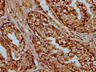 IHC image of the antibody diluted at 1:25 and staining in paraffin-embedded human prostate cancer performed on a Leica BondTM system. After dewaxing and hydration, antigen retrieval was mediated by high pressure in a citrate buffer (pH 6.0). Section was blocked with 10% normal goat serum 30min at RT. Then primary antibody (1% BSA) was incubated at 4°C overnight. The primary is detected by a biotinylated secondary antibody and visualized using an HRP conjugated SP system.Rabbit anti-Human HIST1H4A Polyclonal Antibody