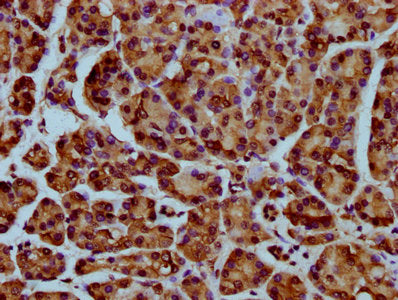 IHC image of HIST1H4A (Ab-35) Antibody diluted at 1:25 and staining in paraffin-embedded human pancreatic cancer performed on a Leica BondTM system. After dewaxing and hydration, antigen retrieval was mediated by high pressure in a citrate buffer (pH 6.0). Section was blocked with 10% normal goat serum 30min at RT. Then primary antibody (1% BSA) was incubated at 4°C overnight. The primary is detected by a biotinylated secondary antibody and visualized using an HRP conjugated SP system.Rabbit anti-Human HIST1H4A Polyclonal Antibody