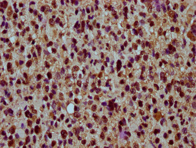 IHC image of the antibody diluted at 1:30 and staining in paraffin-embedded human glioma performed on a Leica BondTM system. After dewaxing and hydration, antigen retrieval was mediated by high pressure in a citrate buffer (pH 6.0). Section was blocked with 10% normal goat serum 30min at RT. Then primary antibody (1% BSA) was incubated at 4°C overnight. The primary is detected by a biotinylated secondary antibody and visualized using an HRP conjugated SP system.Rabbit anti-Human HIST1H4A Polyclonal Antibody