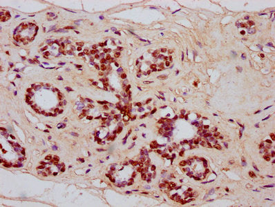 IHC image of HIST1H4A (Ab-77) Antibody diluted at 1:20 and staining in paraffin-embedded human breast cancer performed on a Leica BondTM system. After dewaxing and hydration, antigen retrieval was mediated by high pressure in a citrate buffer (pH 6.0). Section was blocked with 10% normal goat serum 30min at RT. Then primary antibody (1% BSA) was incubated at 4°C overnight. The primary is detected by a biotinylated secondary antibody and visualized using an HRP conjugated SP system.Rabbit anti-Human HIST1H4A Polyclonal Antibody